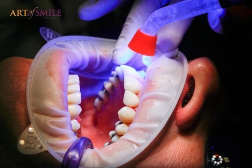 dental filings for cavities dental filings for cavities