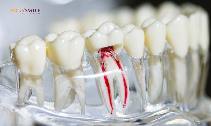 root canal dentist at Yonge and Eglinton root canal dentist at Yonge and Eglinton