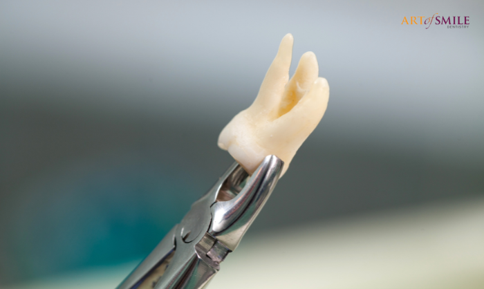 tooth extraction dentist midtown Toronto tooth extraction dentist midtown Toronto